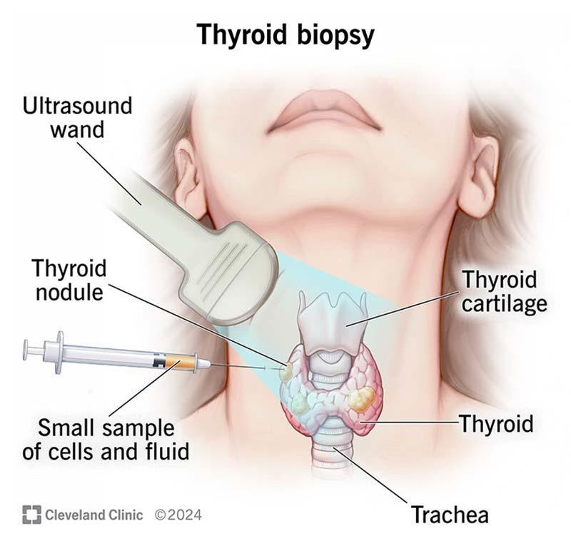ThyroidBiopsy