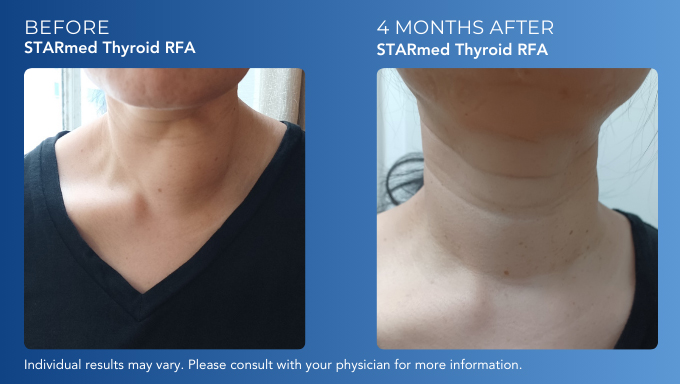 Thyroid RFA Before After